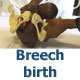 breech birth